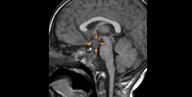 Hypothalamic hamartomas and the foundation that supports these patients
