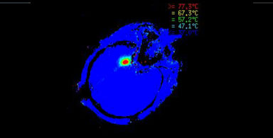 Visualase MRI-Guided Laser Ablation Technology for Minimally Invasive Surgery available at Hackensack, NJ