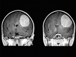 Defining the Cause of Epilepsy