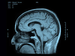 MRI WITH EPILEPSY PROTOCOL